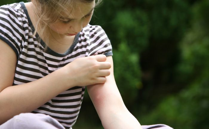 Una niña con una picadura de mosquito